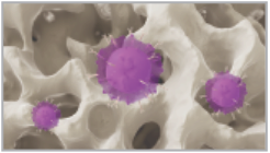 Illustrative graphic showing how irregular T-cell response may destroy platelets in bone marrow and impede platelet production